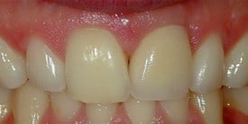 Dental Implant After
