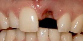 Dental Implant Before